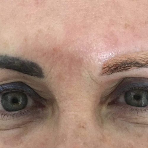 despigmentacion de cejas